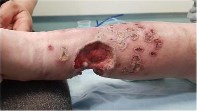 A horse or a zebra? Unusual manifestations of common cutaneous infections in primary immunodeficiency pediatric patients